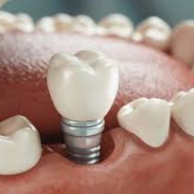 Implante dental en Rosario Santa Fe